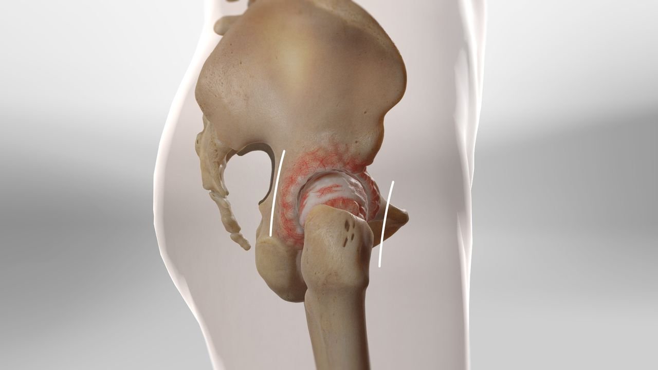 Minimally Invasive