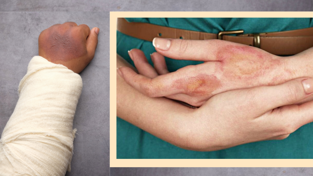 Burn Injuries