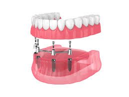 Say Goodbye to Dentures with Dental Implants Gateshead