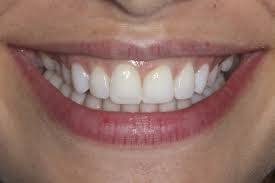 Want a New Smile Without Braces? Choose Composite Bonding Middlesbrough 