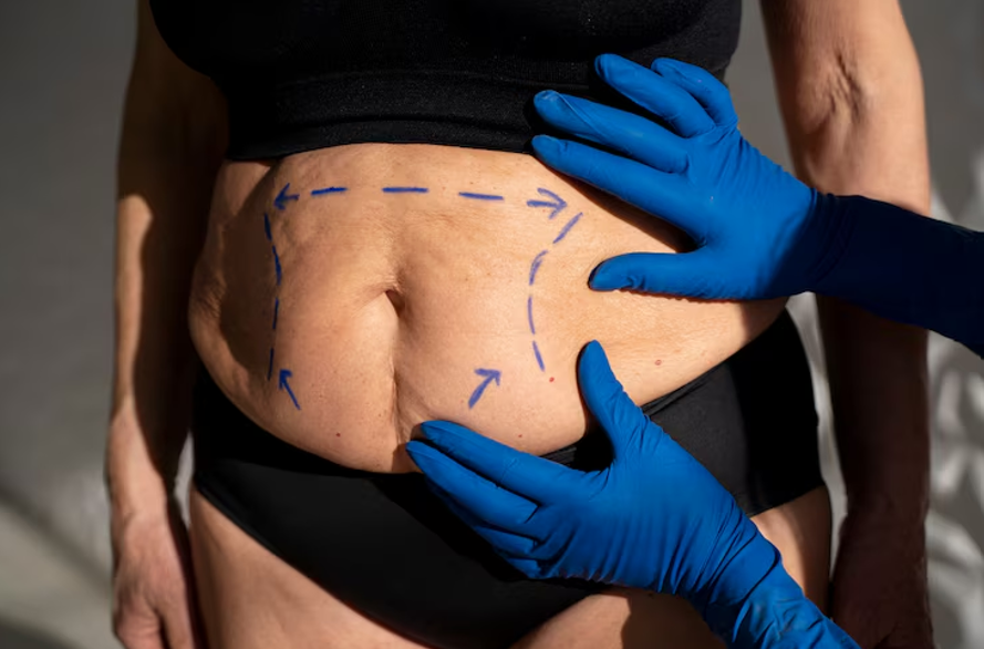 How 360 Body Lift Addresses Excess Skin After Weight Loss